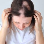 CBT برای اختلال کندن مو: تریکوتیلومانیا یا اختلال کندن مو چیست؟